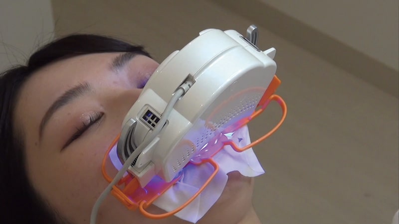 オフィスホワイトニング(ブリリカビアンコ)