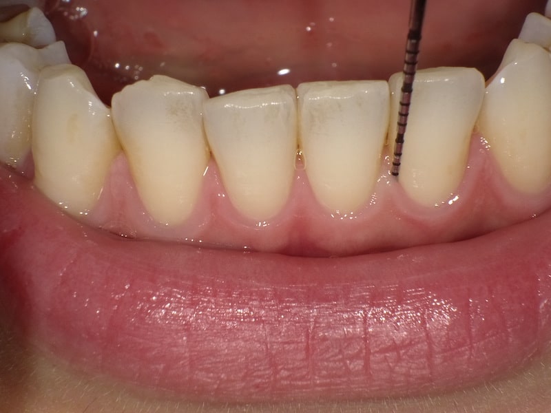 ブラッシング状態、歯、歯肉のチェック