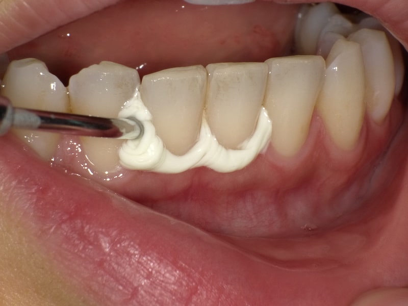 STEP2 研磨ペーストの注入