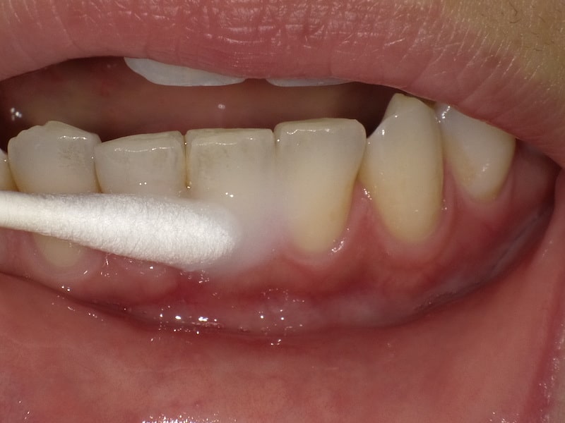 STEP5 フッ化物の塗布